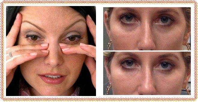 Синяки под глазами у женщин: причины появления, симптомы, лечение в домашних условиях
