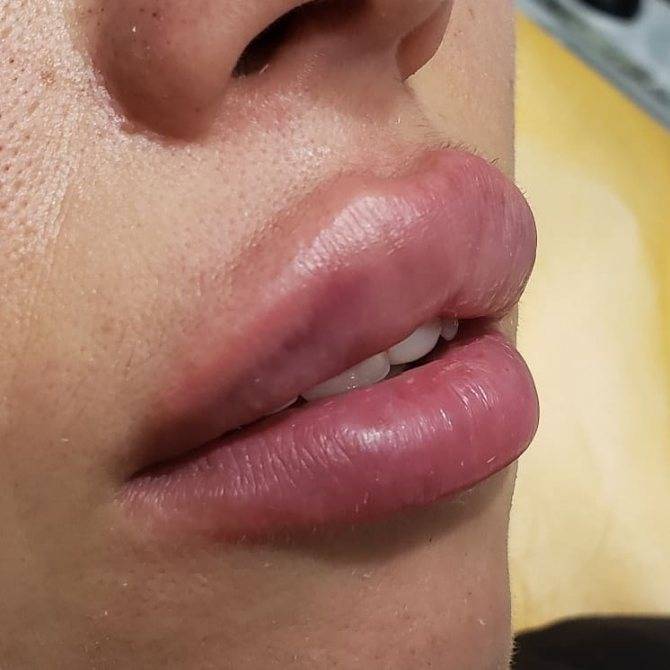 Синяк на губе (гематома): как быстро убрать (избавиться), что делать, лечение