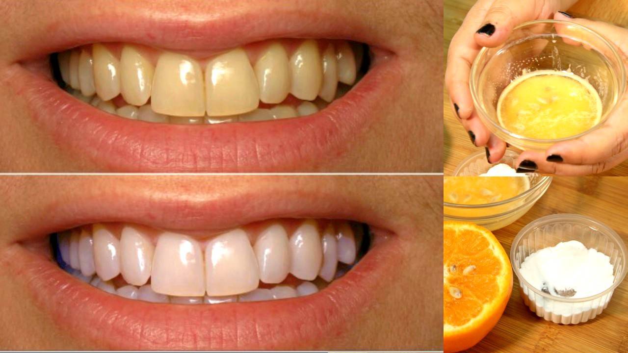 отбеливание зубов в домашних условиях с лимоном