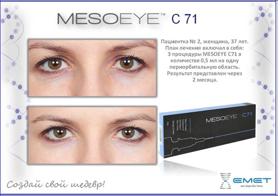 Препарат MESOEYE c71. Мезотерапия MESOEYE c71 для области глаз. МЕЗОАЙ С 71. Мезовартон МЕЗОАЙ. Реви айс
