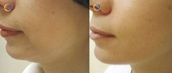 Тренд современности – физиологичность и безопасность. возможности эрбиевого и неодимового лазеров в коррекции возрастных изменений