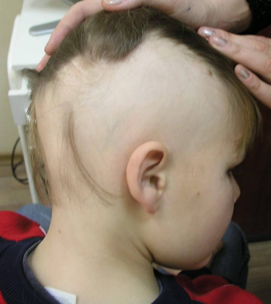 Выпадают волосы у ребенка 7 лет. Гнёздная (очаговая алопеция). Очаговая алопеция офиазис.