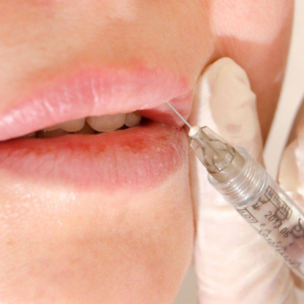 Как увеличить губы инъекции