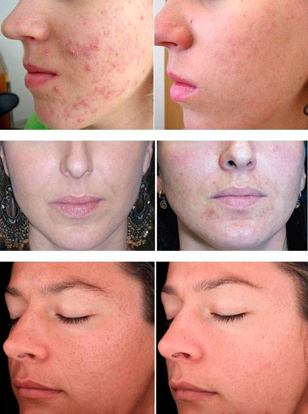 Срединный пилинг лица: что это такое, виды, результаты до и после