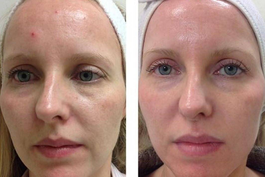 В каких случаях нужно делать мезотерапию?