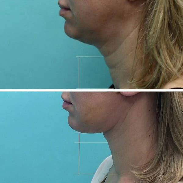 Дряблая кожа на шее и мешок под подбородком убираются за 1 процедуру