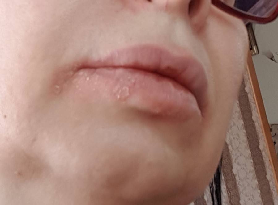 Прыщи вокруг рта: почему они появляются и как от них избавиться