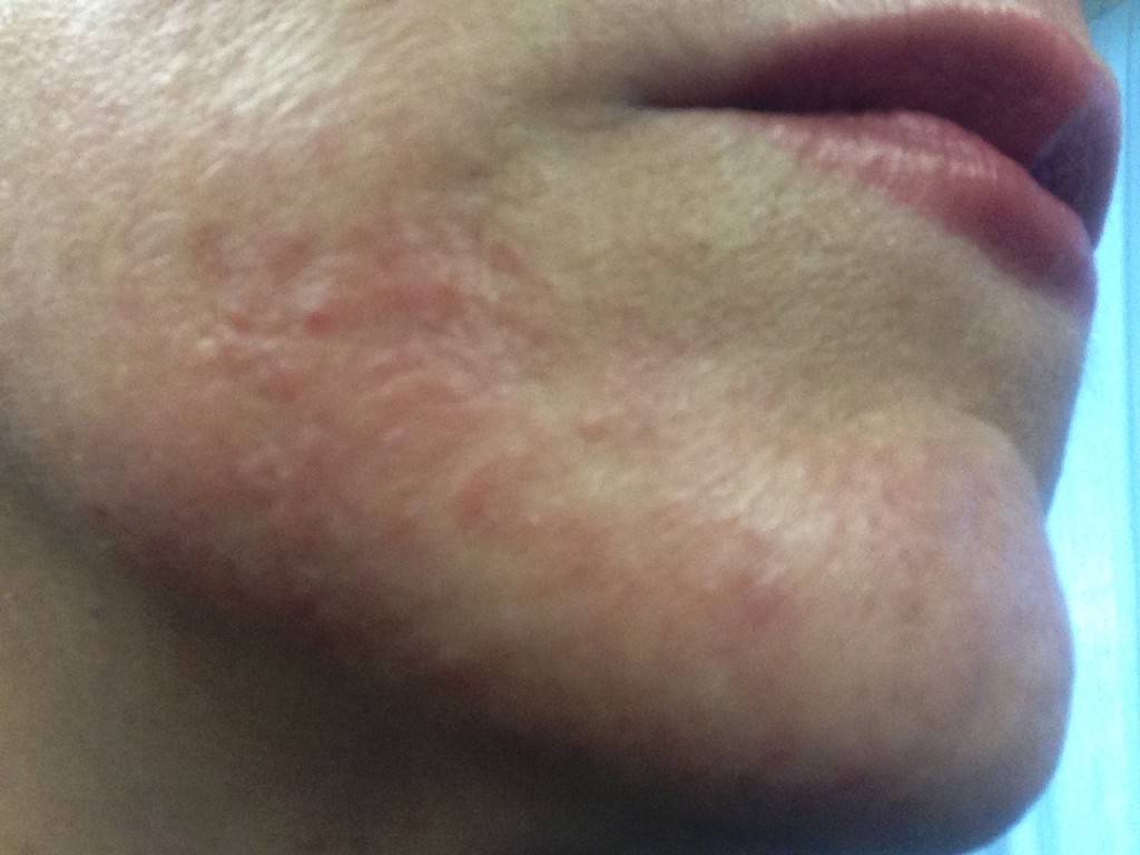 Прыщи на подбородке у мужчин: причины появления, процедура устранения в домашних условиях | mfarma.ru