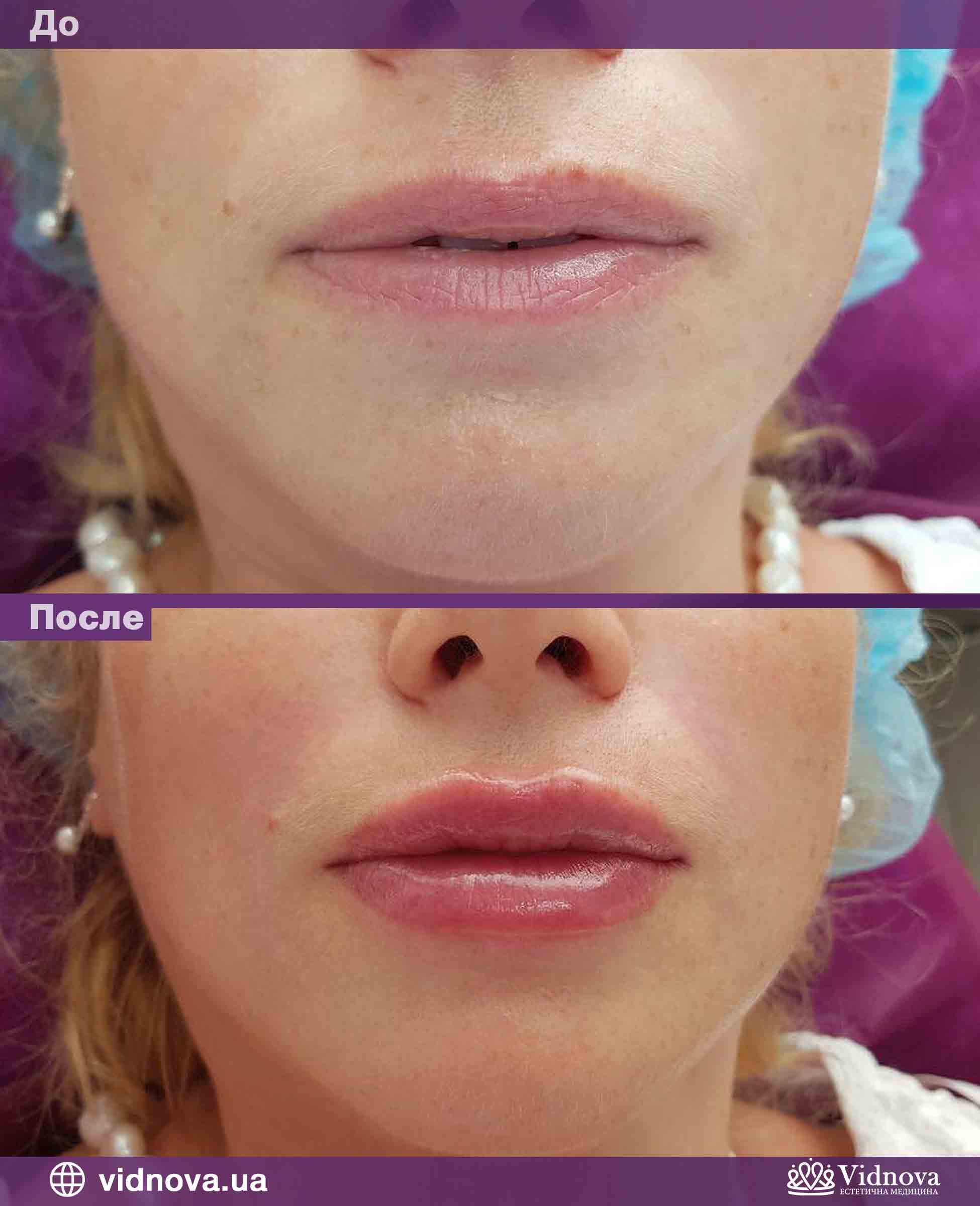Контурная пластика губ: показания, подготовка, фото до и после