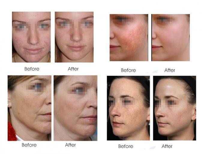 Дарсонваль от морщин – как правильно пользоваться в домашних условиях для лица