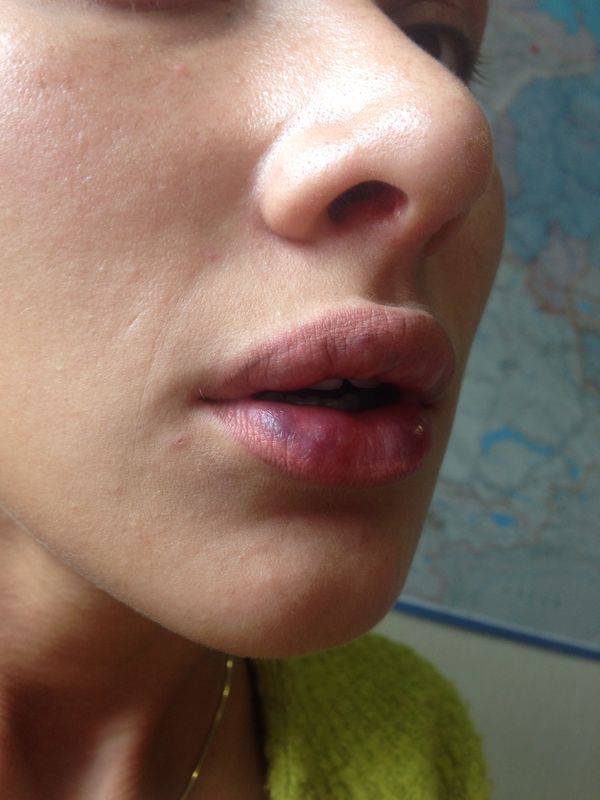 Синяки после биоревитализации под глазами и на губах – как быстро убрать и лечить, когда проходят