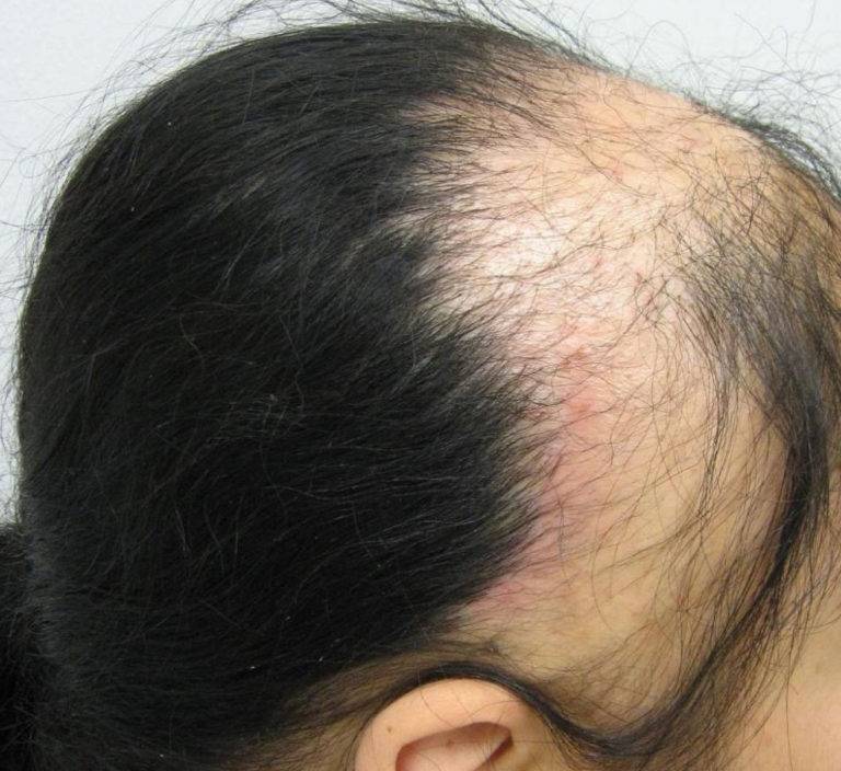 Выпадение волос у женщин после 40, 50, 60 лет: причины и лечение