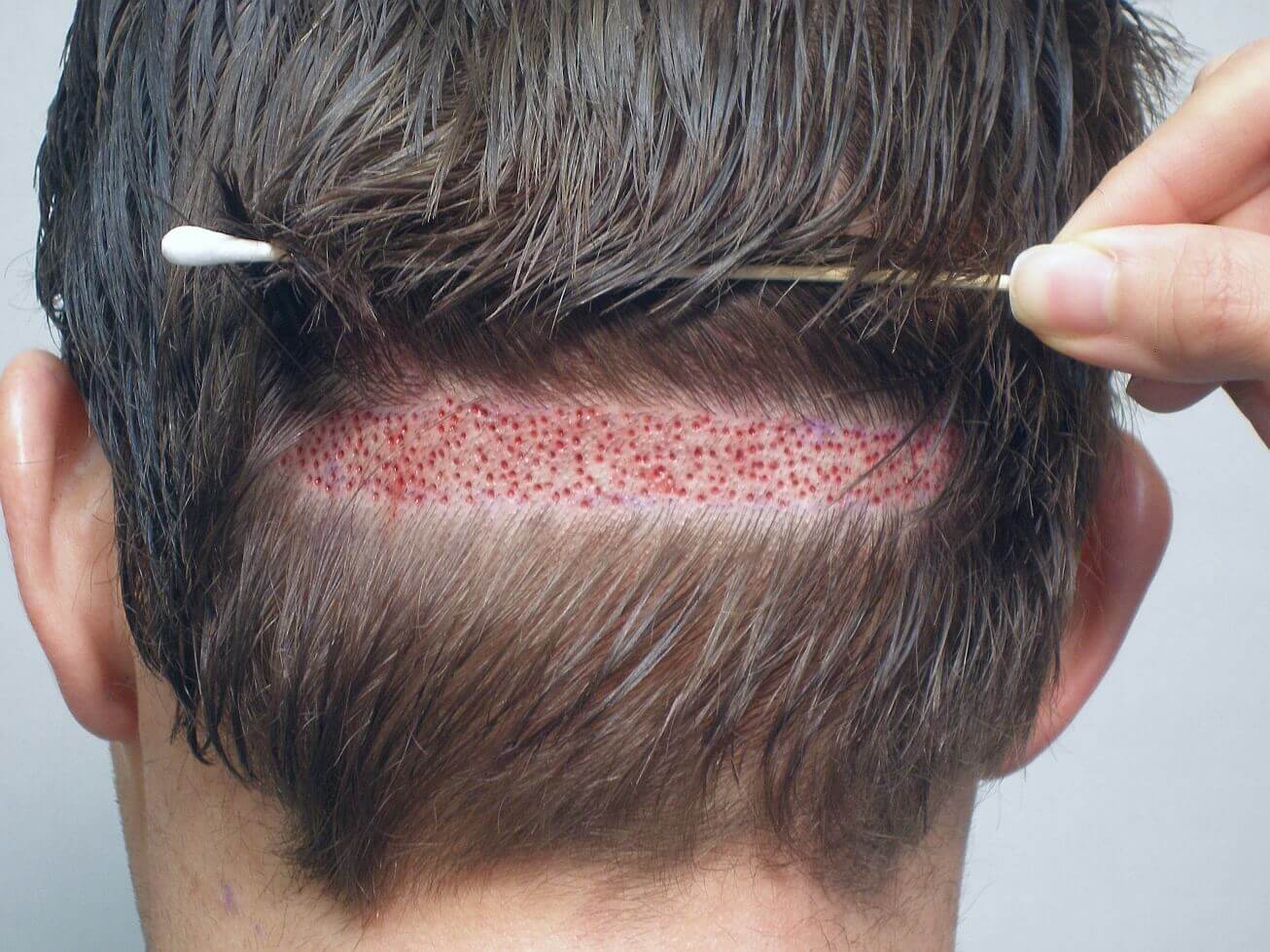 Как можно повредить волосяные луковицы на голове