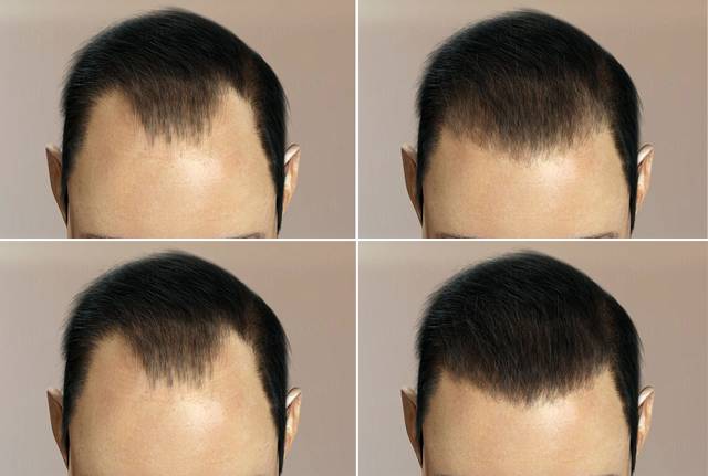 Какой метод пересадки волос лучше?