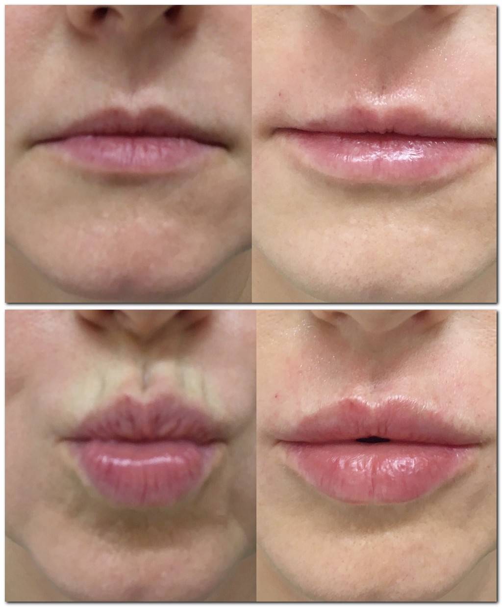 Филлер для увеличения губ: как проходит процедура, фото до и после