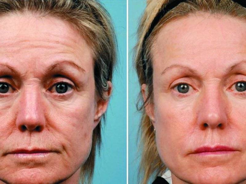 Плазмолифтинг отзывы фото до и после лицо. Плазмолифтинг (плазмотерапия). Плазменный лифтинг лица. Плазмолифтинг для лица.