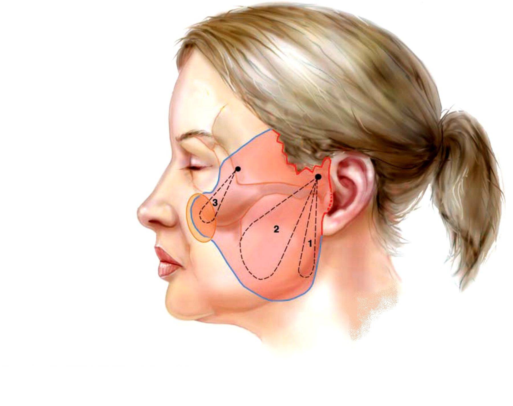 Подтяжка мышц лица. Операция смас лифтинг операция. Анатомия брылей на лице.