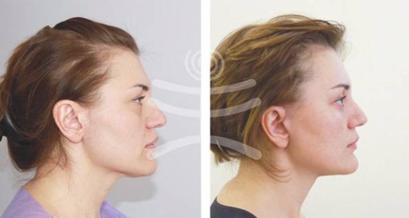 Лифтинг мендельсона — описание метода, преимущества, противопоказания