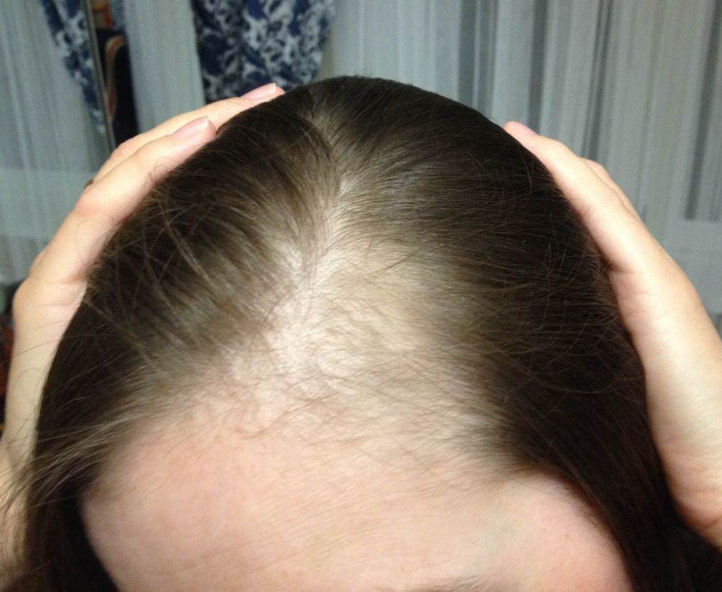 Выпадения волос у девушек — причины и способы лечения