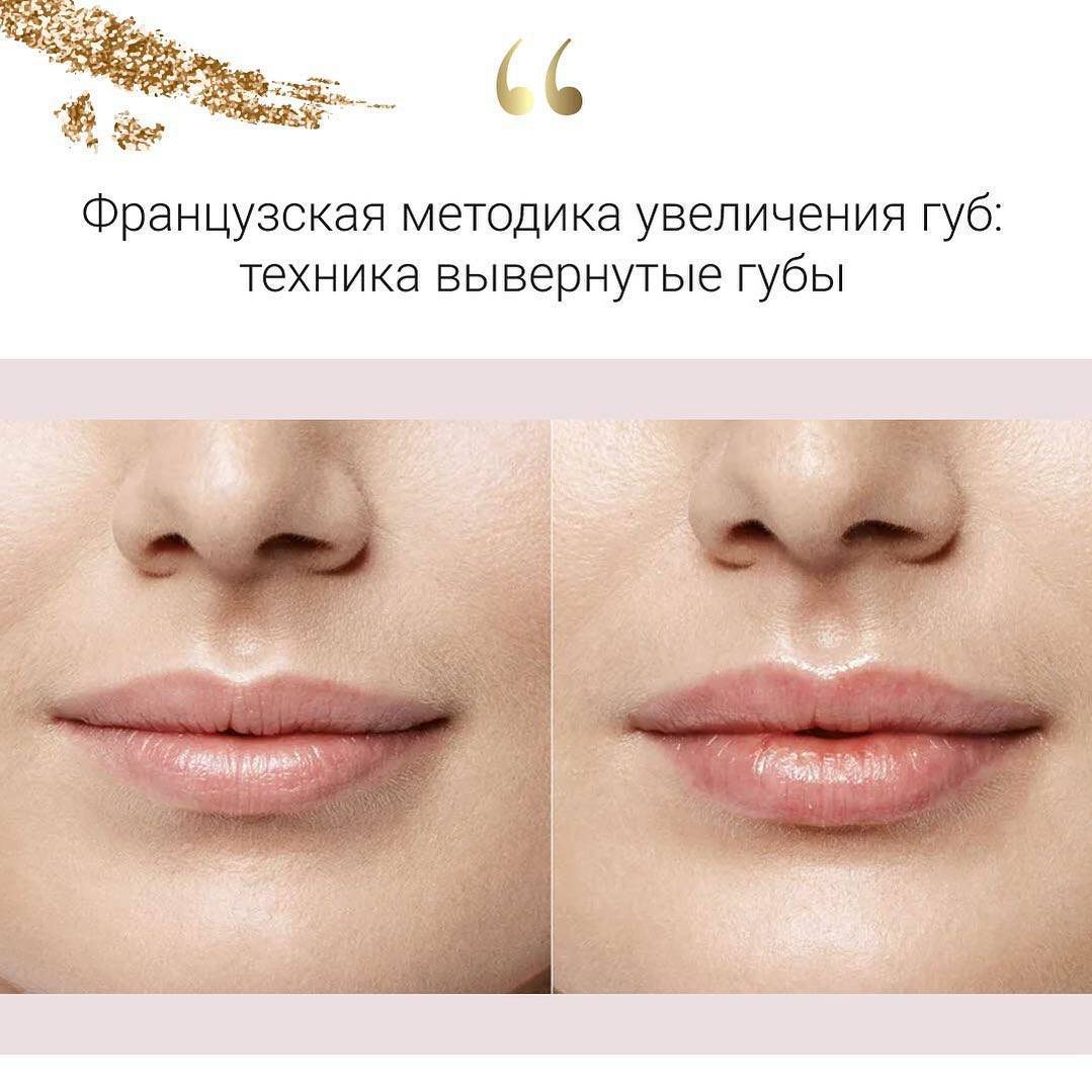 Парижские (французские) губы: техника увеличения, фото до и после | dlja-pohudenija.ru