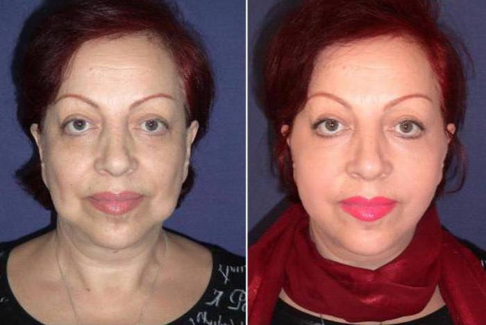 Комки биша: удаление, последствия, фото звезд до и после + видео и отзывы