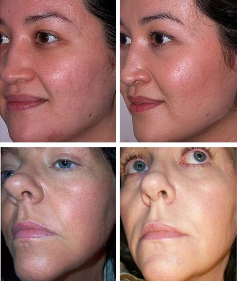 Мезотерапия дермахил отзывы | глазной.ру