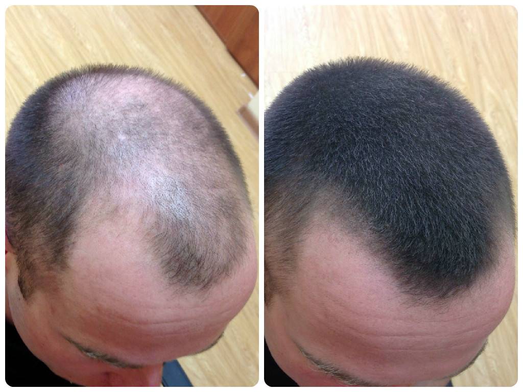 Почему выпадают волосы на голове у мужчин: причины и лечение