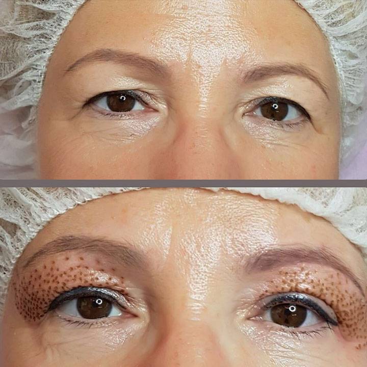 Безоперационная блефаропластика век: отзывы, цены на плазменную бесконтактную подтяжку, лучшие аппараты для лифтинга плазмой верхних и нижних век — plasma pen, pencil и другие