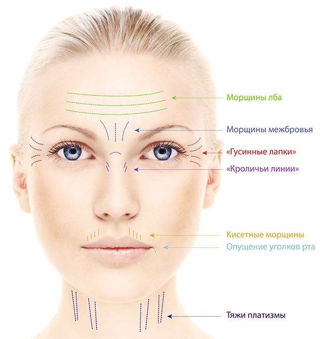 Как убрать морщины над верхней губой - средства и процедуры для женщин