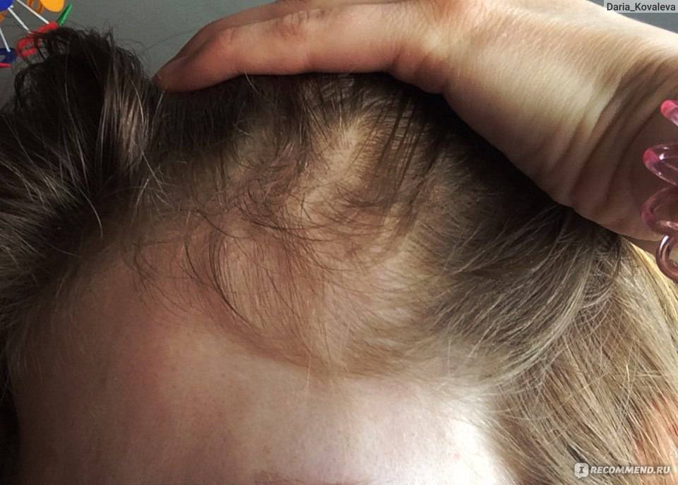 Ответы на все вопросы: почему выпадают волосы после родов у кормящих мам, влияет ли пролактин на облысение при грудном вскармливании и многое другое