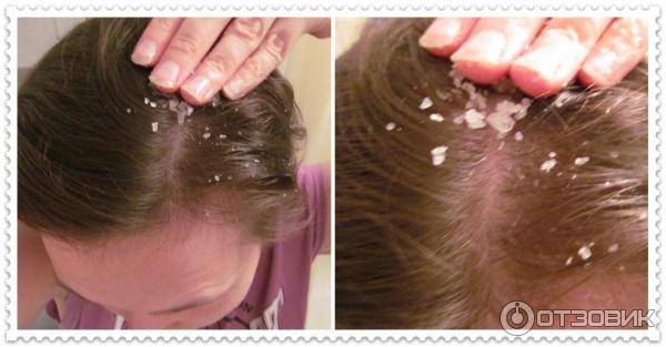 Что такое солевой пилинг для волос