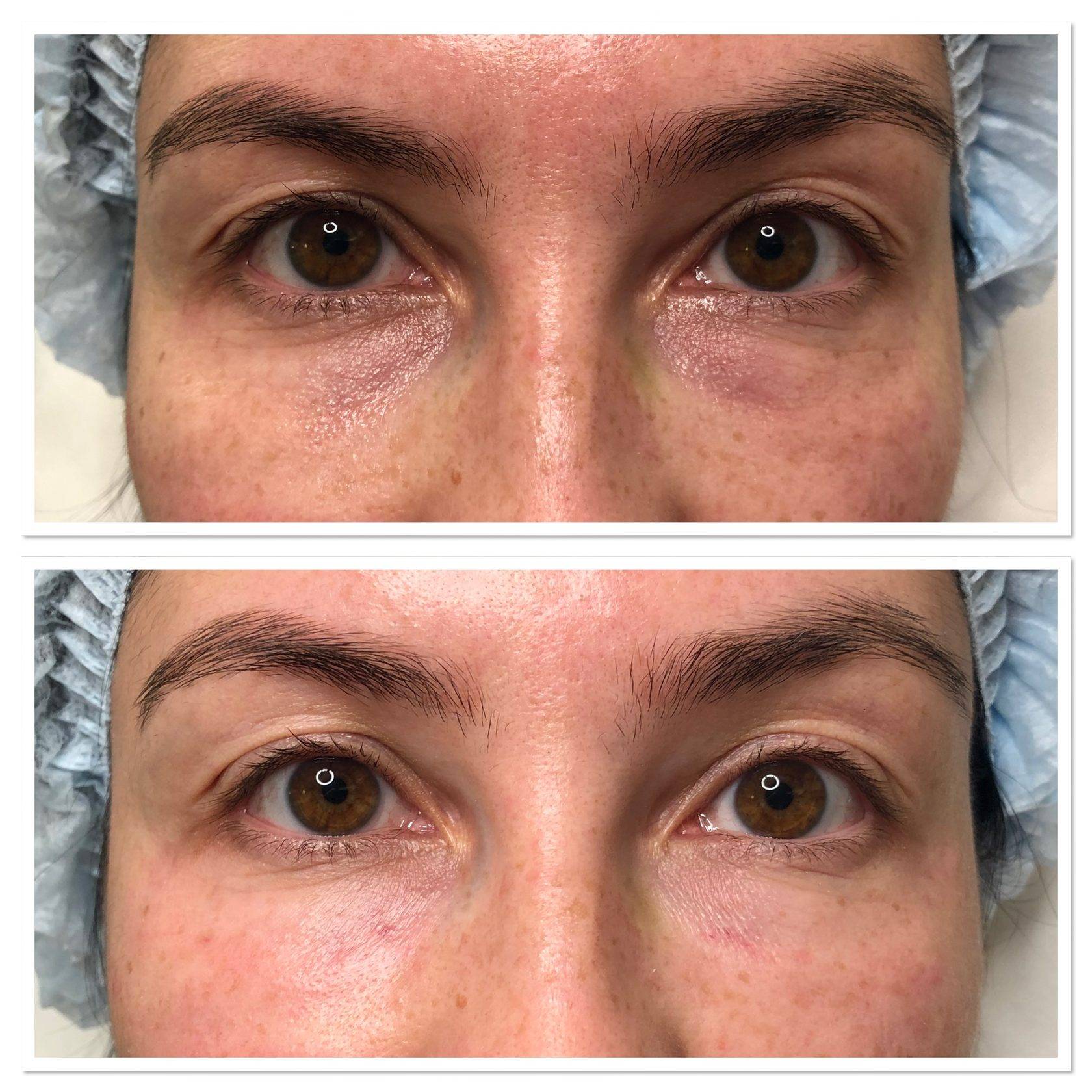 Хронические синяки и темные круги под глазами: как бороться?