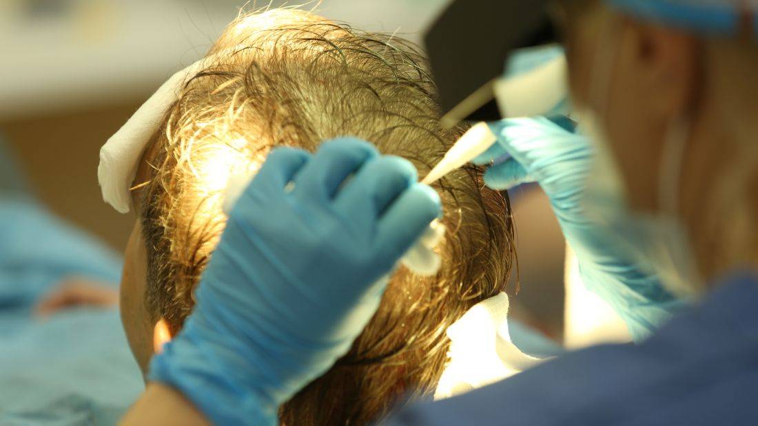 В каких случаях пересадка волос противопоказана взрослым людям