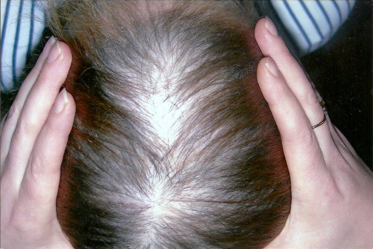 Ваша шевелюра редеет? выясняем в чем причины сильного выпадения волос