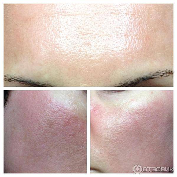 Маска для лица из бадяги с перекисью водорода, глиной, от прыщей, морщин, пигментных пятен. отзывы