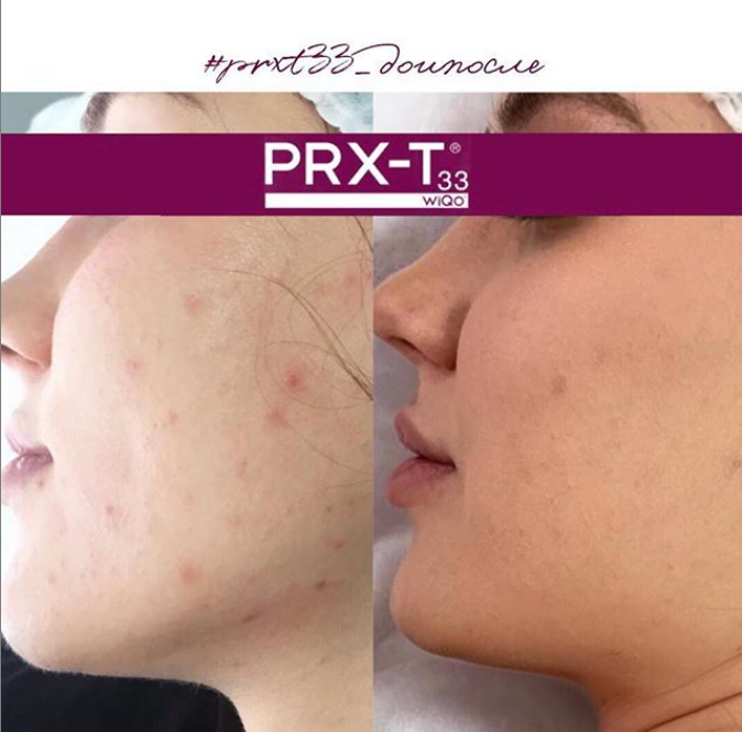Пилинг prx-t33 — омоложение кожи без инъекций