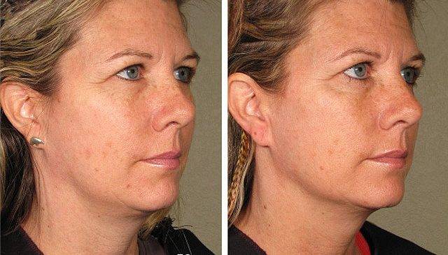Smas-лифтинг (27 фото): ультразвуковая аппаратная процедура подтяжки лица, что это такое, отзывы