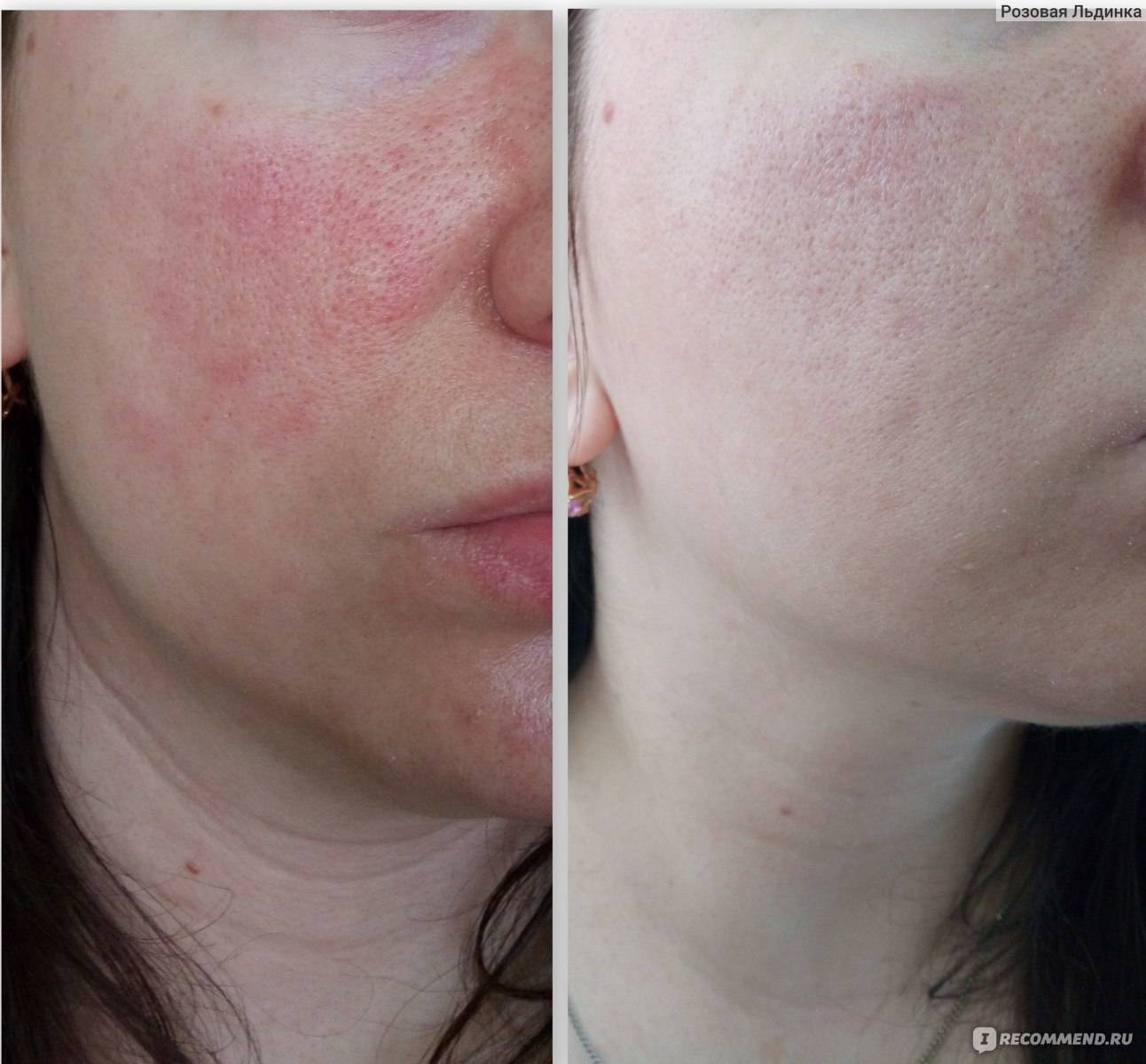 Себорея на лице: лечение, 4 мази от себорейного дерматита, таблетки от жирной кожи и негормональные крема - лечение