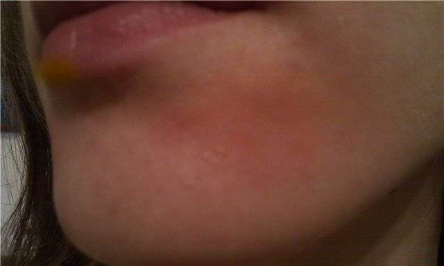 Шелушение кожи на подбородке. когда стоит обратиться к врачу?