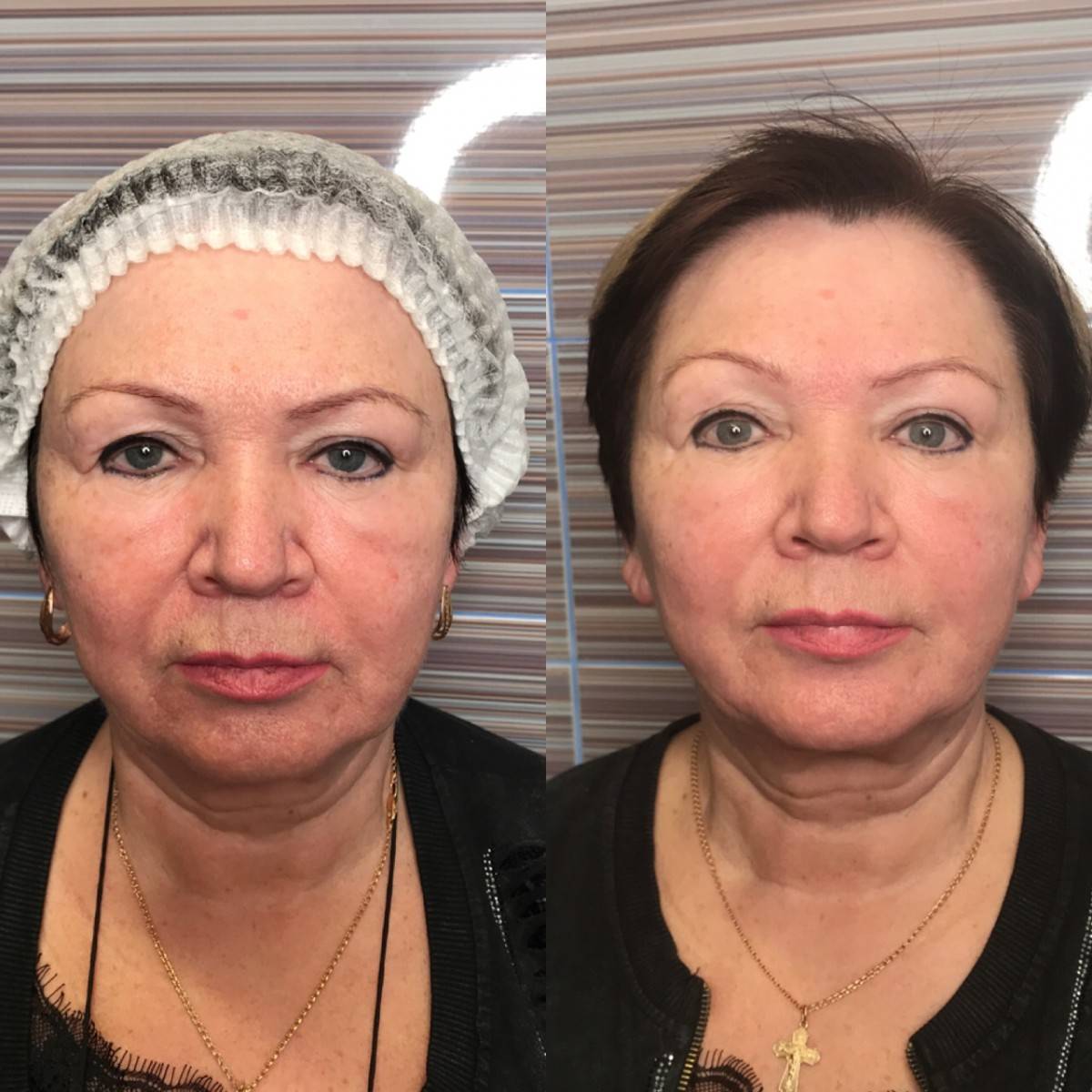 Миофасциальный массаж лица