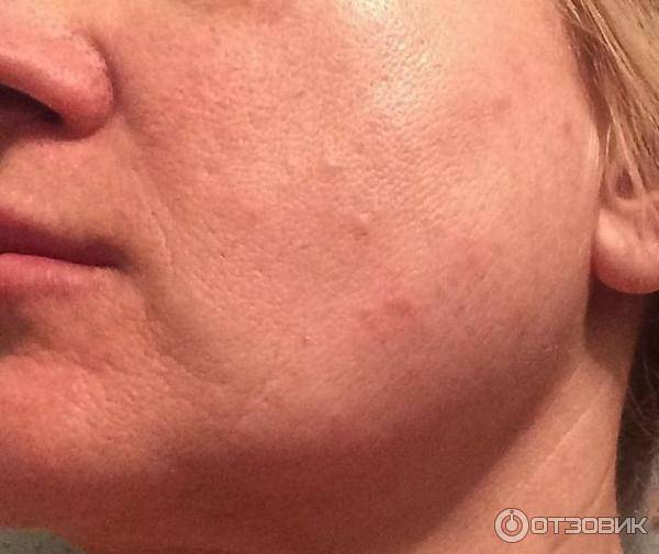 Отзывы о биоревитализации аминояль стронг (amino jal)