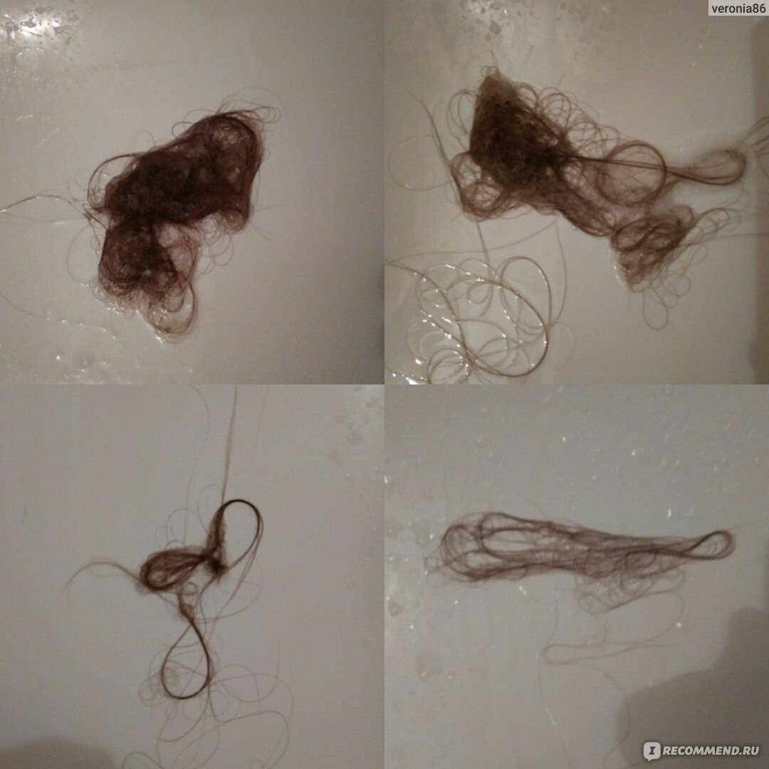 Почему выпадают волосы после мытья. Луковица волоса. Волос с волосяной луковицей. Выпадают волосы с волосяной луковицей. Выпадение волос с луковицей.