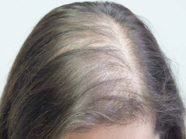 Причины выпадения волос у девушек подростков: почему очень сильно редеют волосы у довочек, основные факторы влиящую на густоту локонов