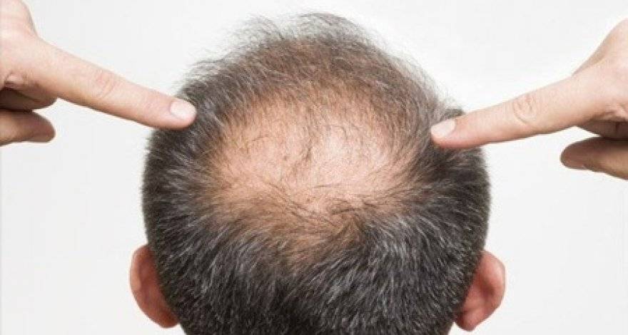 При остеопорозе могут выпадать волосы