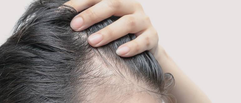 Выпадения волос у девушек — причины и способы лечения