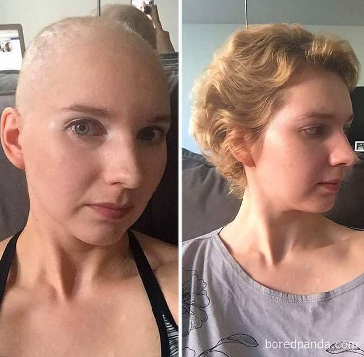 Через сколько времени после химиотерапии начинают расти волосы на