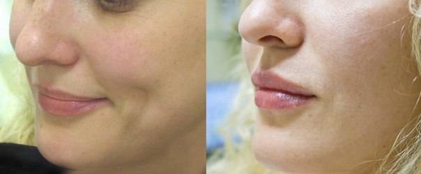 Биоревитализация губ до и после. Биоревитализация губ гиалуроновой кислотой. Увлажнение губ биоревитализация.