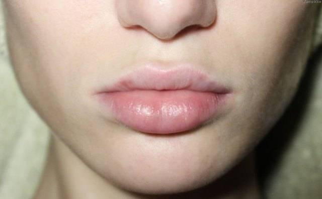 Неудачное увеличение губ: причины и способы избежать осложнений