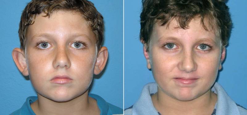 Фото операции на уши до и после операции