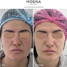 Канюли для контурной пластики: фото и отзывы